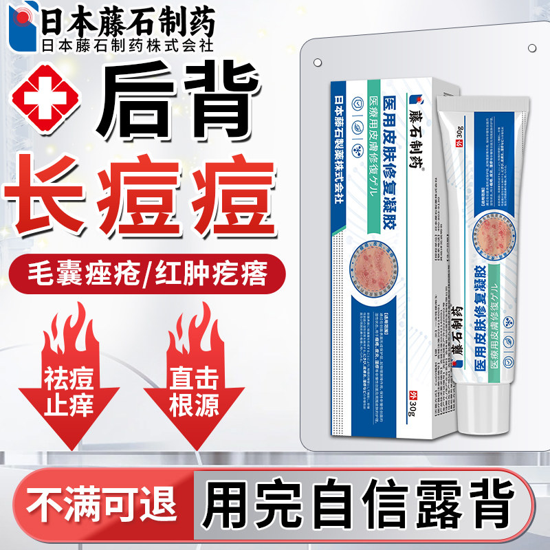 后背前胸长痘痘毛囊炎沐浴露马拉色菌除螨净痘去硬疙瘩可搭药膏ZR