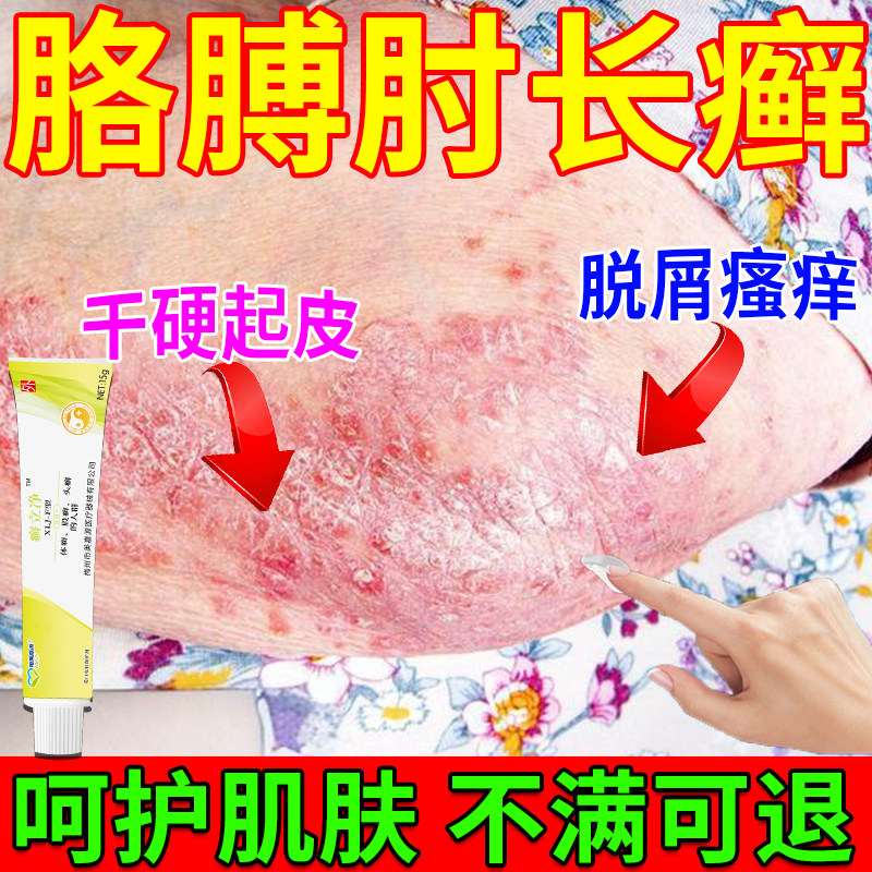 手肘癣胳膊肘长癣去干硬起皮脱屑瘙痒红斑丘疹根皮癣真菌感染xe