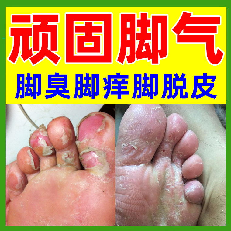 水泡型脚气脚气止痒脱皮杀菌喷雾脱皮烂脚丫抑菌脚癣去真菌感染