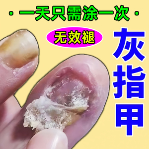 灰指甲抑菌液脱甲膏去除增厚治疗脚趾甲精油非治疗正品旗舰店药水