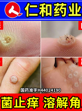 仁和水杨酸去老茧鸡眼贴专用膏祛除鳮茧眼根脚钉跖疣尤平软化剂nz