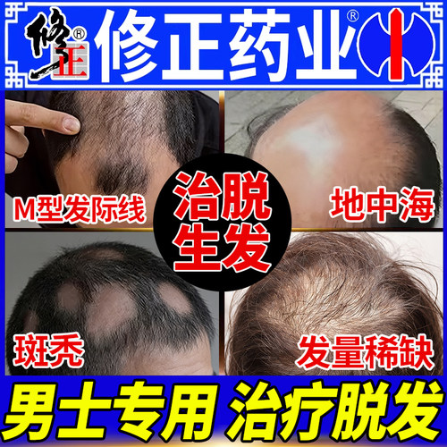 男士防脱发生发液治疗男士斑秃脱发生发的药