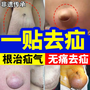 疝气贴腹股沟中老年特专效用日本膏药脐疝带小肠成人治肚脐贴正品