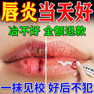 唇炎皮肤冻疮嘴唇干裂脱皮儿童成人医用级润唇膏保湿滋润补水专用