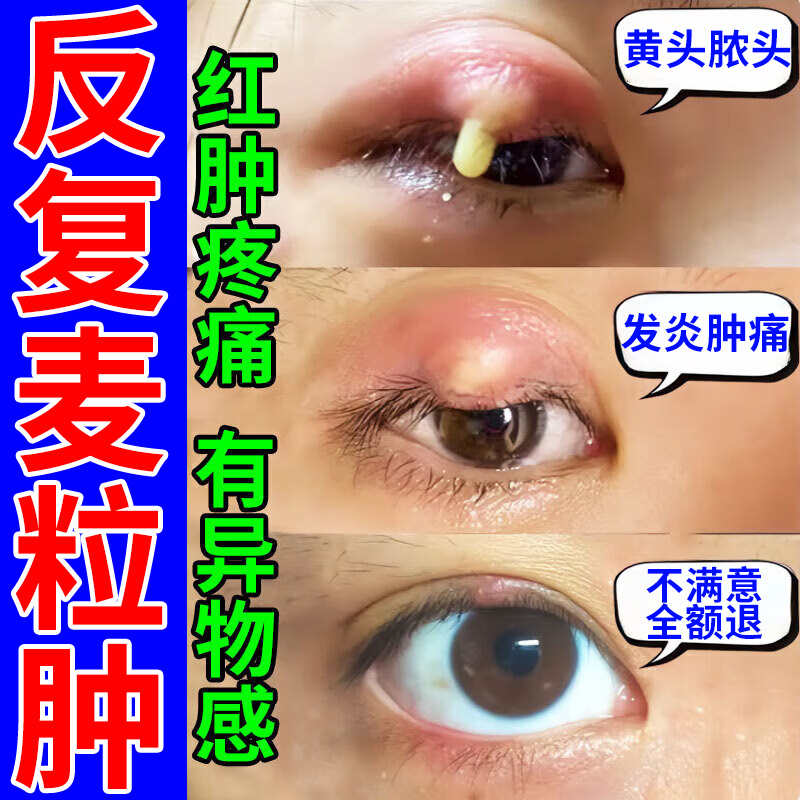 麦粒肿800%裉除【不满意全额退】