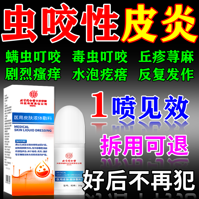 虫咬性皮炎丘疹性荨麻疹专用