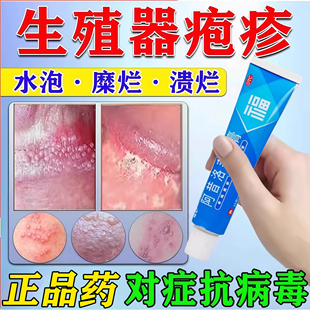 阿昔洛韦软膏乳膏正品抗病毒治生殖器疱疹单纯疱疹带状疱疹专用药