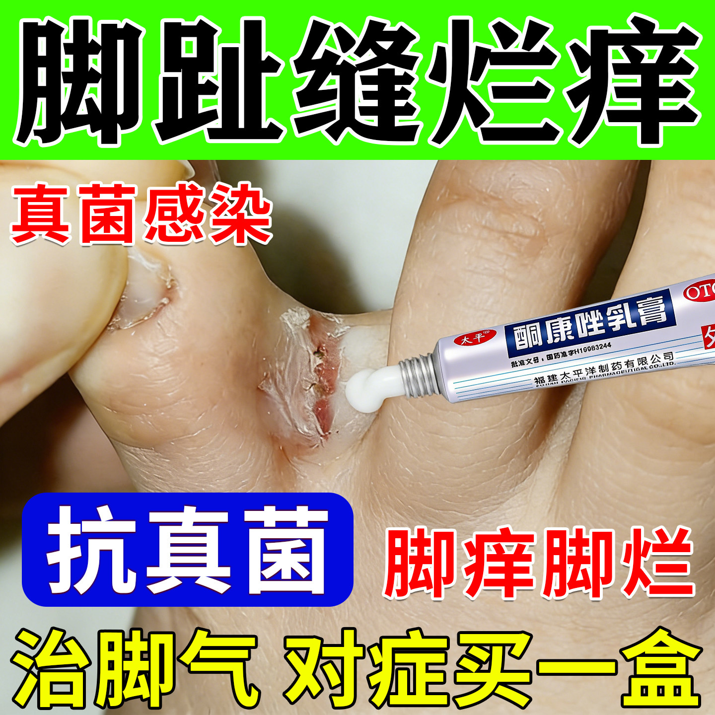脚气烂脚丫专用药膏脚气止痒脱皮杀菌真菌感染专用酮康唑乳膏正品