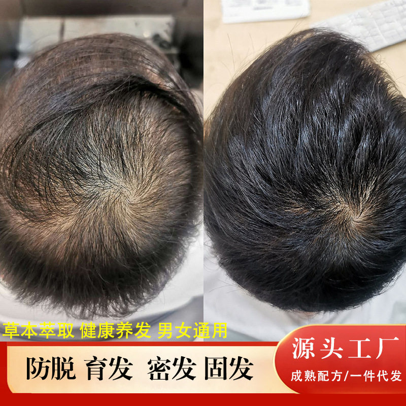 何首乌育发液防脱育发增发密发固发养发坚韧发根发际线头发滋养液