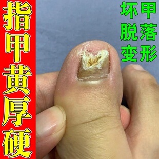 指甲发黄变厚变硬脚趾甲真菌性感染灰甲白甲空甲床分离修复液专用
