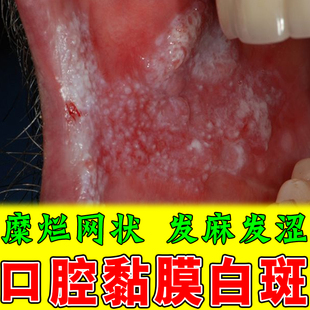 口腔白色念珠菌粘膜修复溃烂糜烂扁平舌头白斑充血嘴发麻发涩灼热