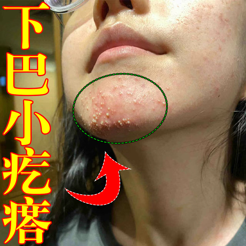 去下巴闭口粉刺膏下巴长红肿痘痘淋巴痘腮边痘内调理消痘膏