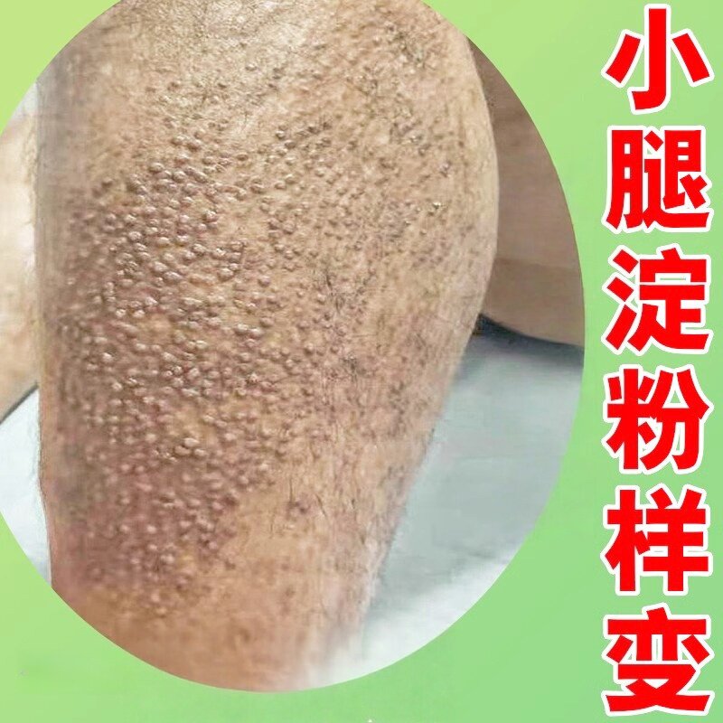 小腿皮肤痒严重神经性红疹过敏痒皮肤淀粉样变专用膏