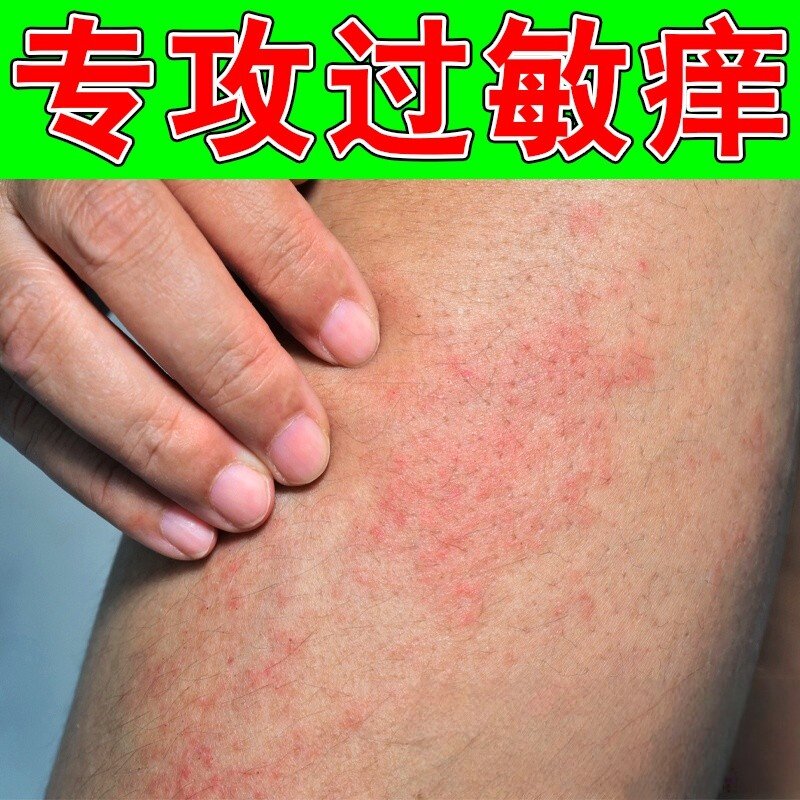 过敏痒无激素软膏身上皮肤痒起红疙瘩手臂红斑肿胀长红疙瘩痒