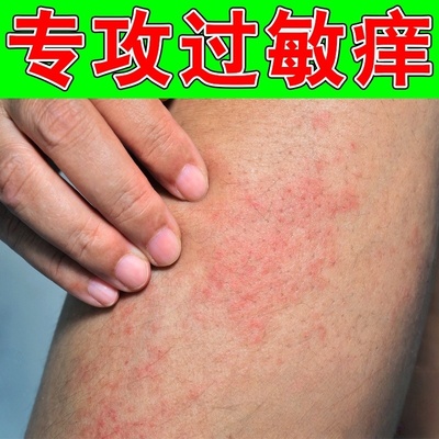 过敏痒无激素软膏身上皮肤痒起红疙瘩手臂红斑肿胀长红疙瘩痒