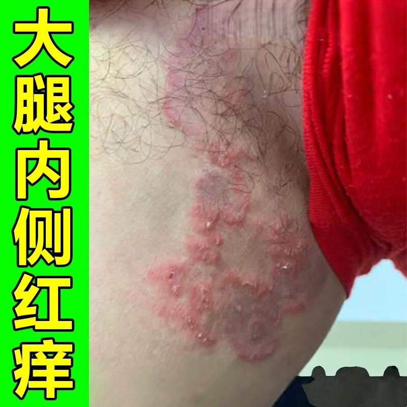 治大腿内侧痒男士股鲜屁股痒红斑真菌感染专用软膏