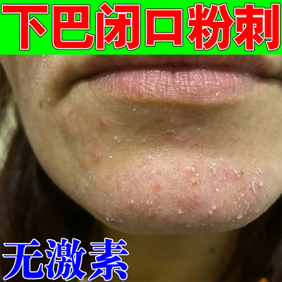 去下巴闭口粉刺的脸部额头痘痘粉刺下巴冒白尖祛痘专用膏