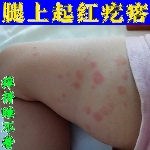 身上起红疙瘩痒去皮肤红点儿童大腿有红色丘疹痒专用喷剂
