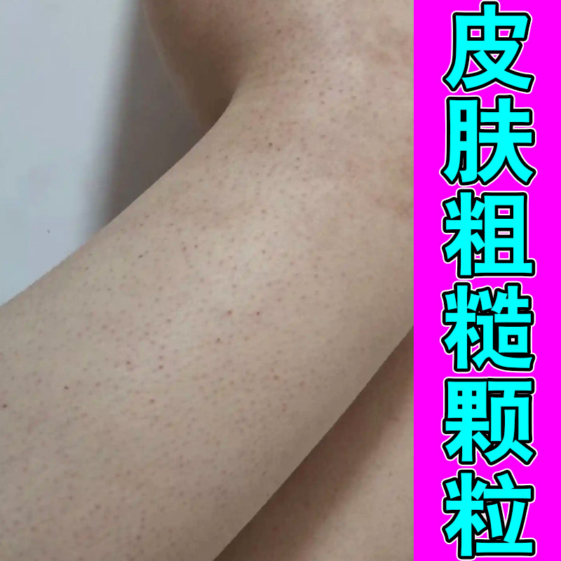 皮肤粗糙颗粒手臂上长小疙瘩痘毛囊堵塞毛周角化毛孔粗大修护保湿