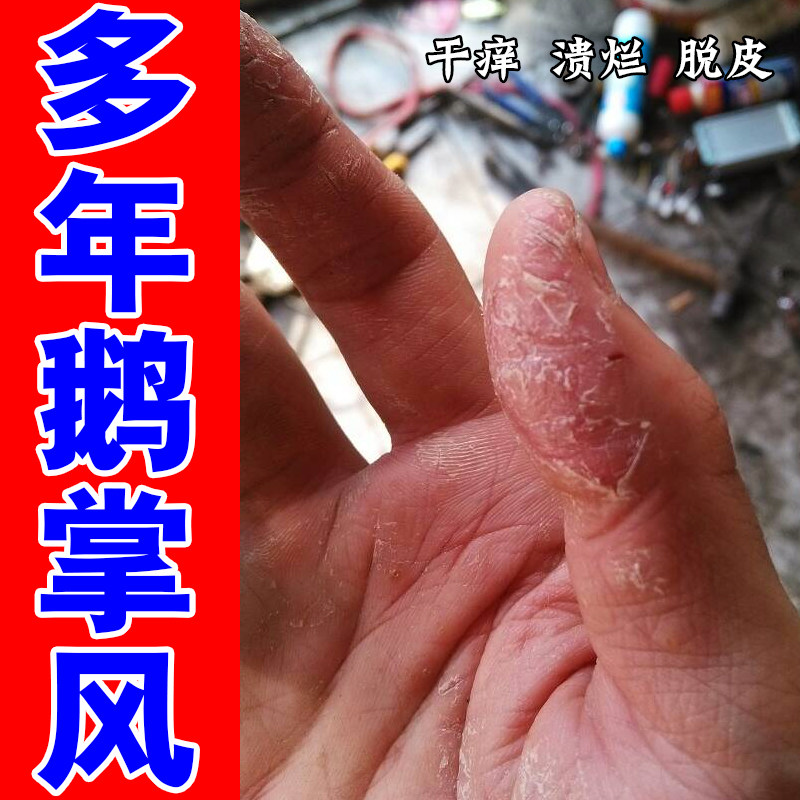 手裂口子手粗糙干裂口手痒角质层增厚手部去死皮手背开裂