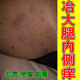 冶大腿内侧痒皮肤痒私处痒潮起小红疙瘩红肿疙瘩坐疮专用修复药