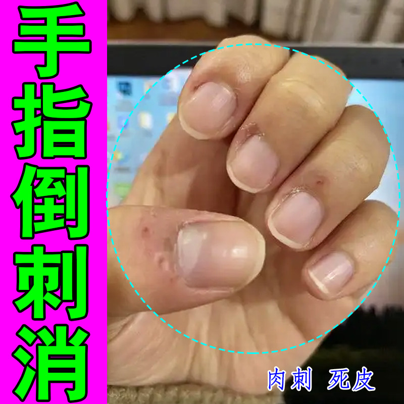 手指倒刺消指甲边缘长肉刺死皮手指甲边缘表皮撕裂脱皮专用修复膏