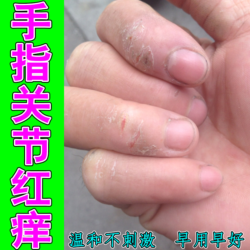 手指关节红痒手裂口子粗糙增厚皮肤痒掉屑起硬皮感染脱皮专用草本