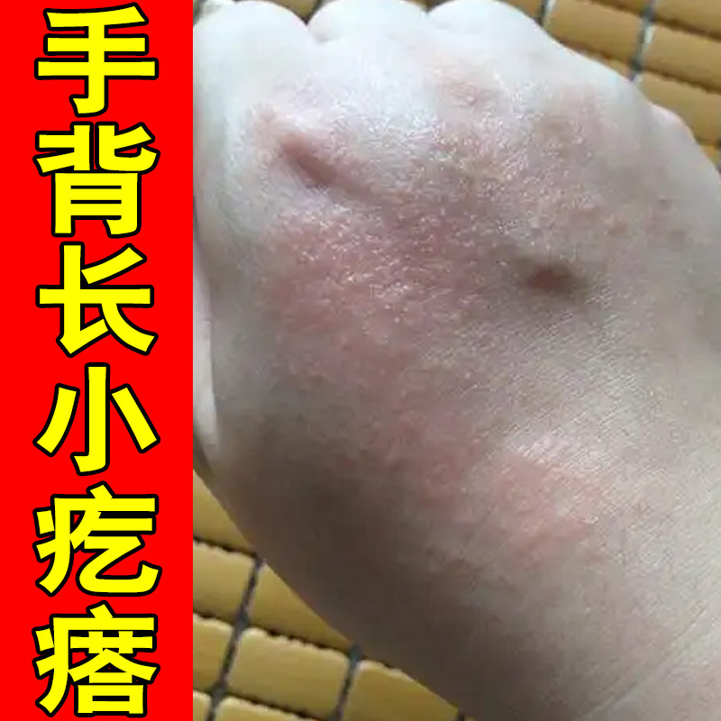 手背长小疙瘩皮肤干燥粗糙掉屑鳞屑手上起小疙瘩水泡沙土性过敏痒