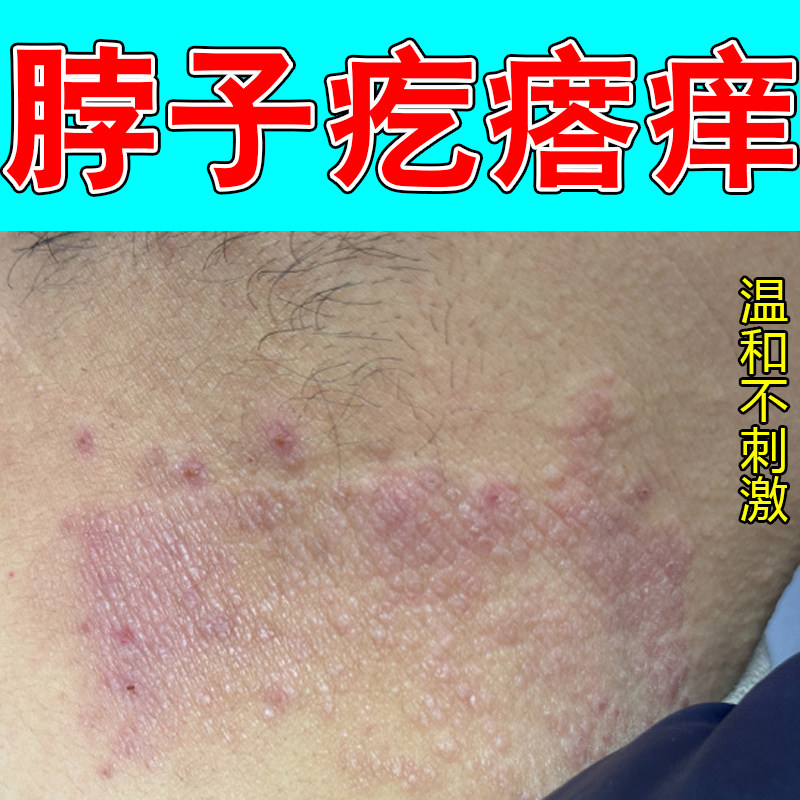 脖子疙瘩痒身上过敏粗糙痒神经性过敏痒掉屑粗糙干燥脖圈红斑修护