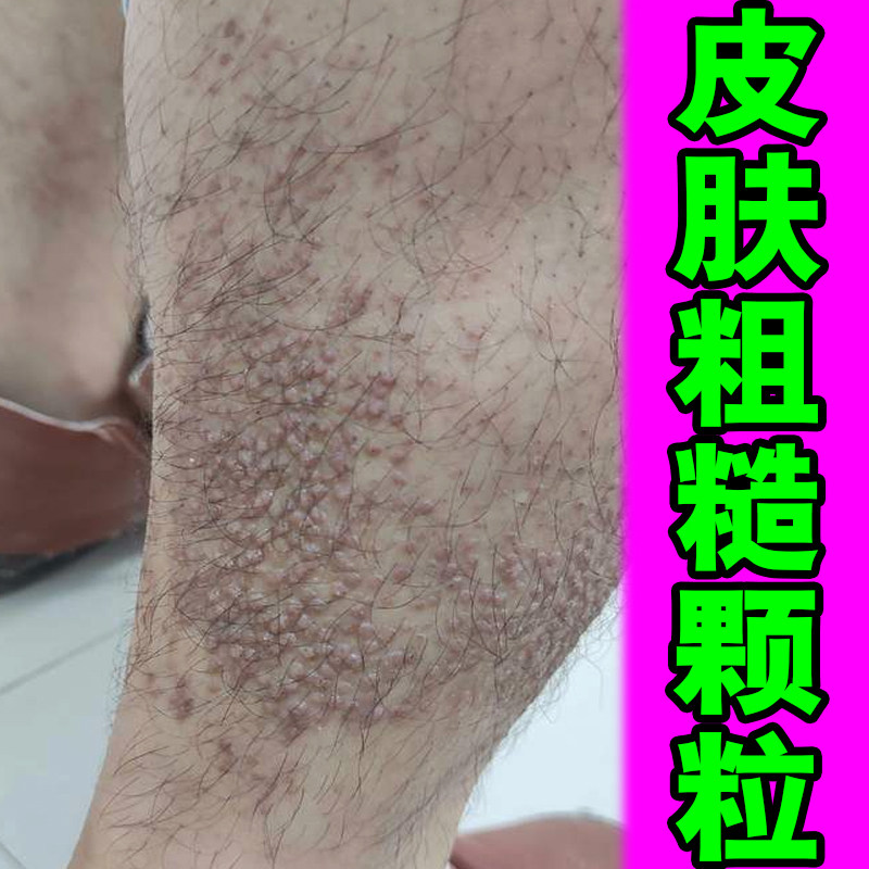 皮肤粗糙疙瘩专用顽固褐色斑点蛋白沉淀皮肤痒起小疙瘩斑块粗糙痒