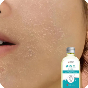 脸上干燥起皮脸干燥干皮脱皮干痒秋冬脸部掉皮发痒皮肤粗糙起干皮