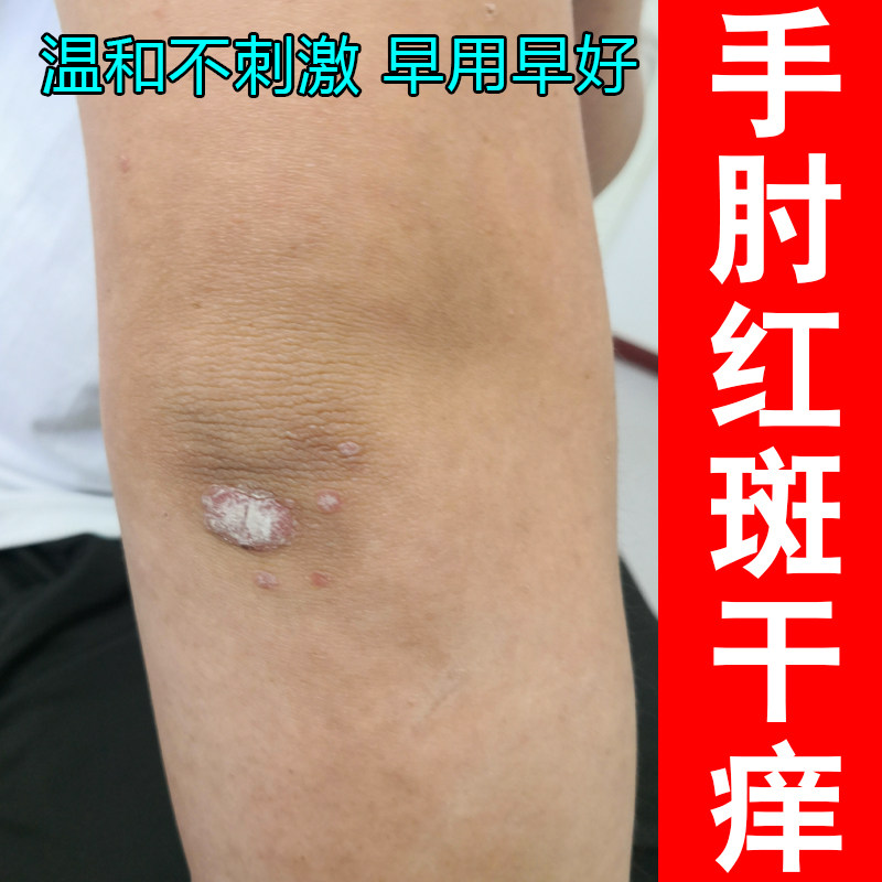 手肘红斑干痒起鳞屑角质层增厚感染起硬皮疙瘩剧烈痒抓挠老年人痒