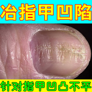 指甲甲床分离竖纹受损指甲凹陷变形手指甲坑洼手指甲修复