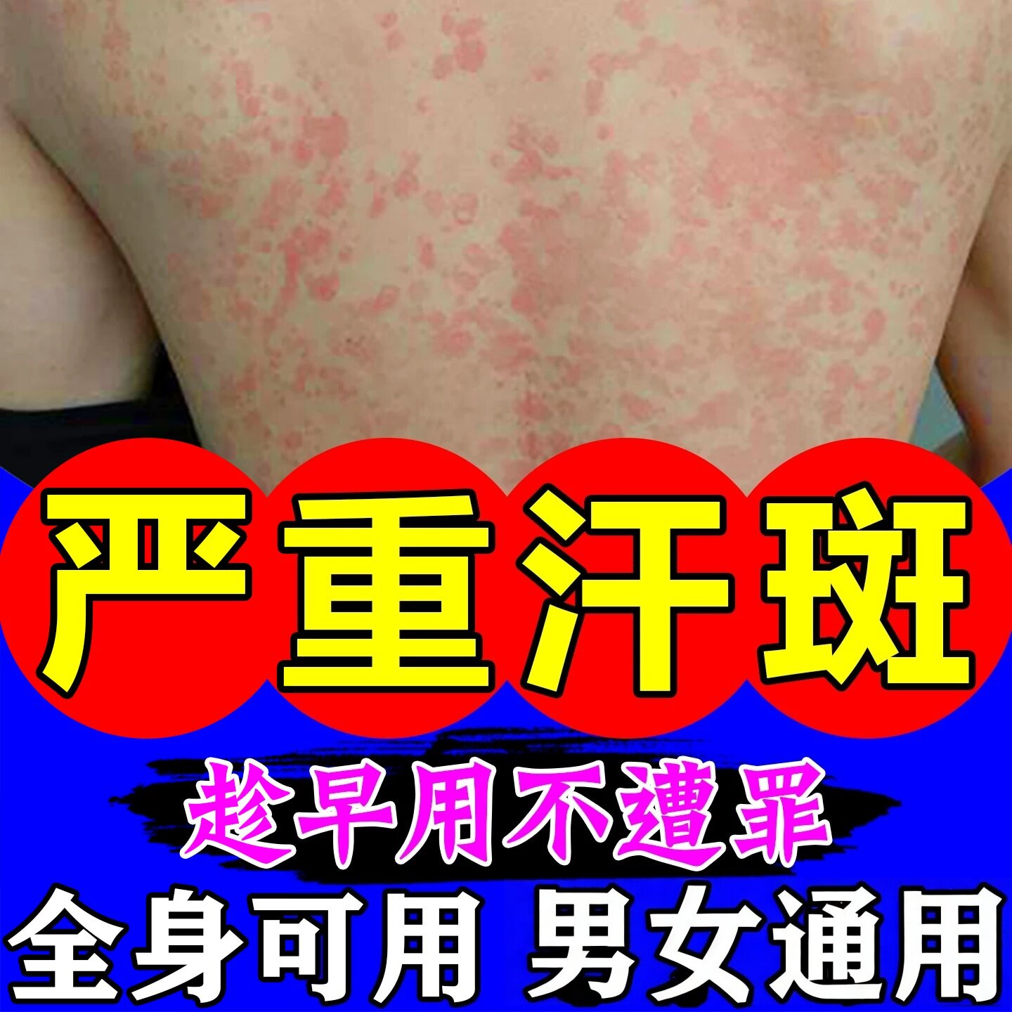 汗斑净花斑药胸前后背腋下白斑红褐斑皮肤外用膏汗斑