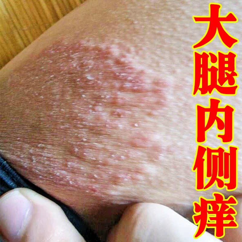 股痒大腿内侧真菌私处皮肤发痒两侧掉屑红斑干燥脱皮红痒专用神器