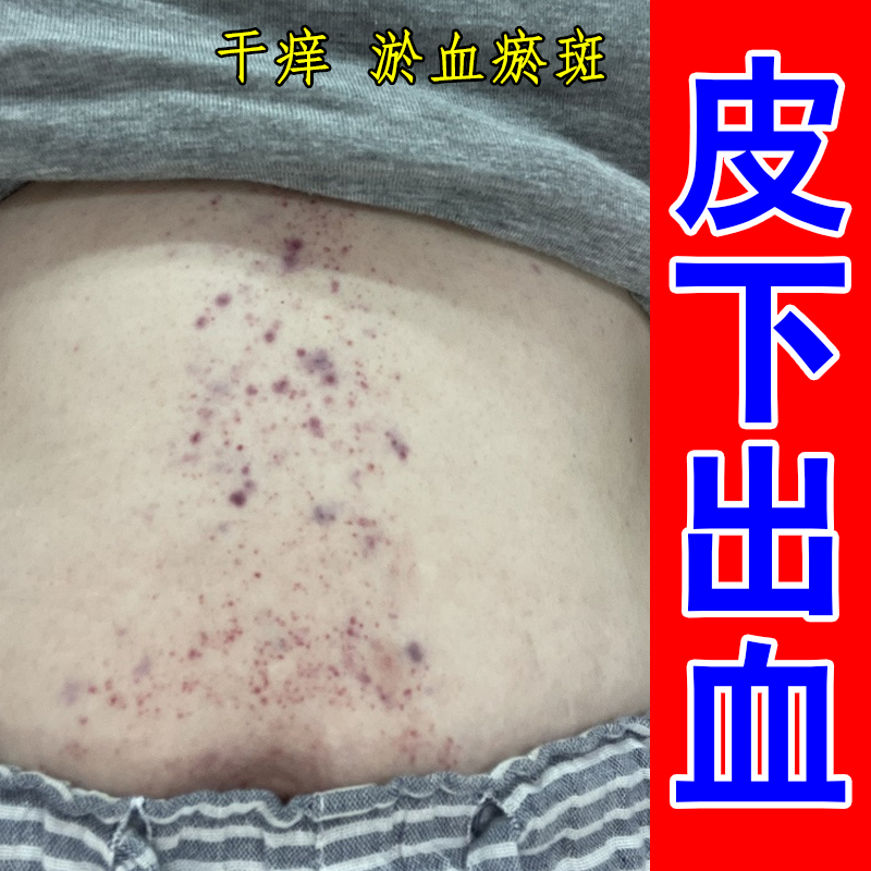 紫点外用药过敏性紫殿冶老年性色素紫瘀斑红四肢皮下出血红点药膏