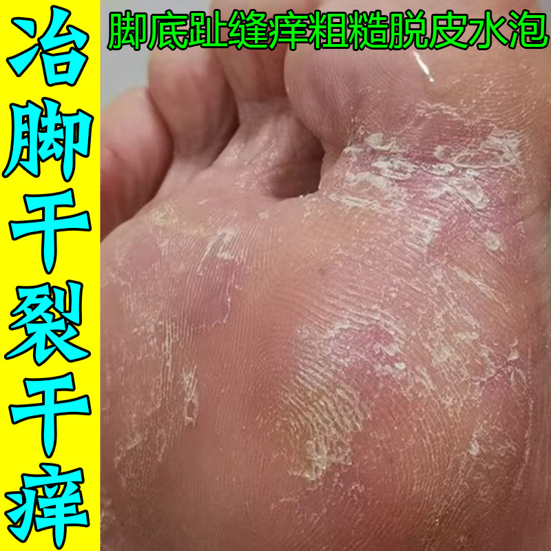 脚底脱皮干燥痒脚趾缝痒严重蜕皮起水泡疙瘩难忍汗脚臭脚草本修复