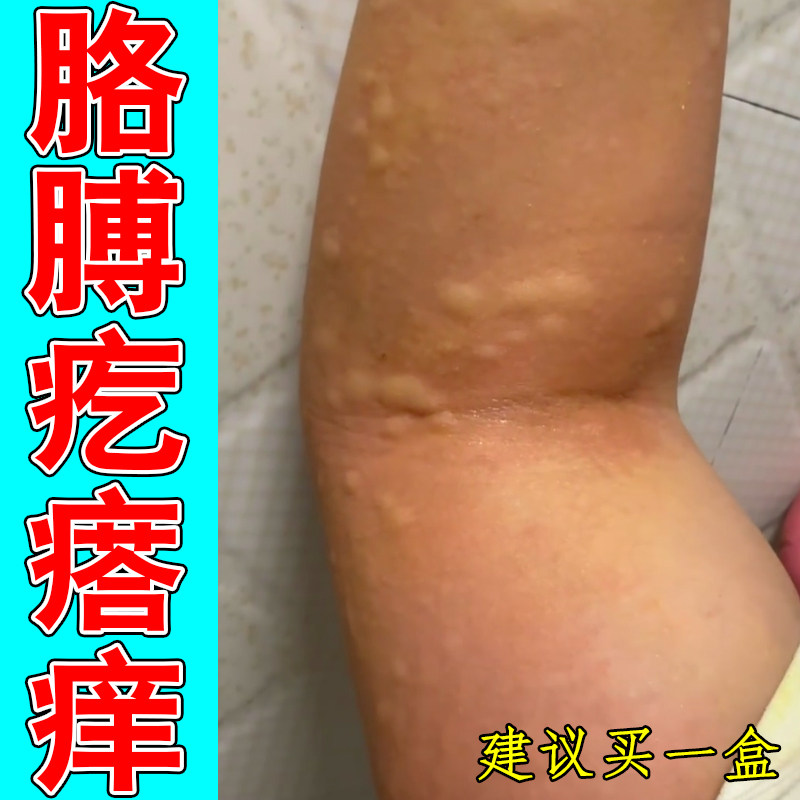 胳膊疙瘩痒身上起红斑风团寒冷性紫外线过敏换季红肿刺挠干燥草本