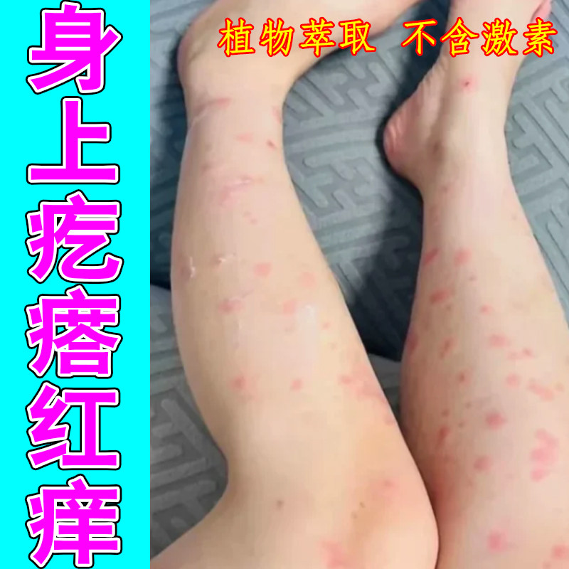 身上疙瘩红痒掉屑粗糙脱皮小腿上长红斑过敏痒老年人身上痒刺挠干