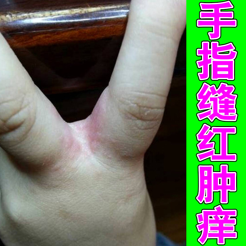 手指缝红肿痒掉屑感染泛白季节性过敏粗糙干燥掉屑手脱皮干裂修护