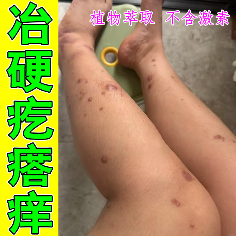 冶硬疙瘩痒腿上红肿痘痒掉屑皮肤红斑痒老年人身上痒睡不着顽固痒
