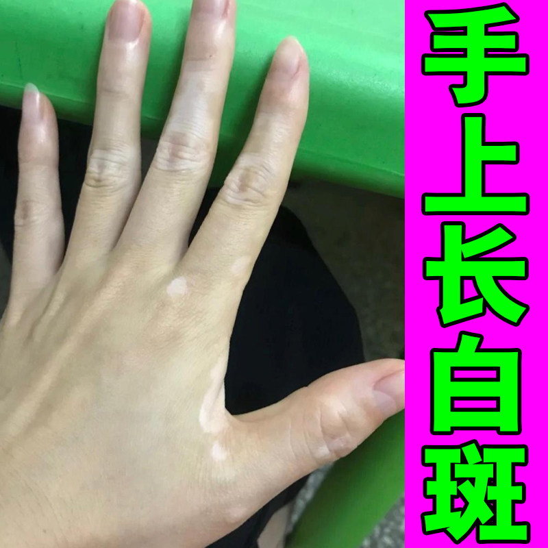 快速消白斑补骨脂酊黑色素生长药