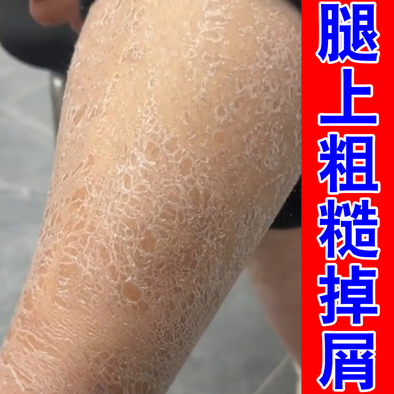 小腿皮肤干燥起白屑润肤霜鱼鳞肌肤全身保湿补水改善粗糙起皮身体
