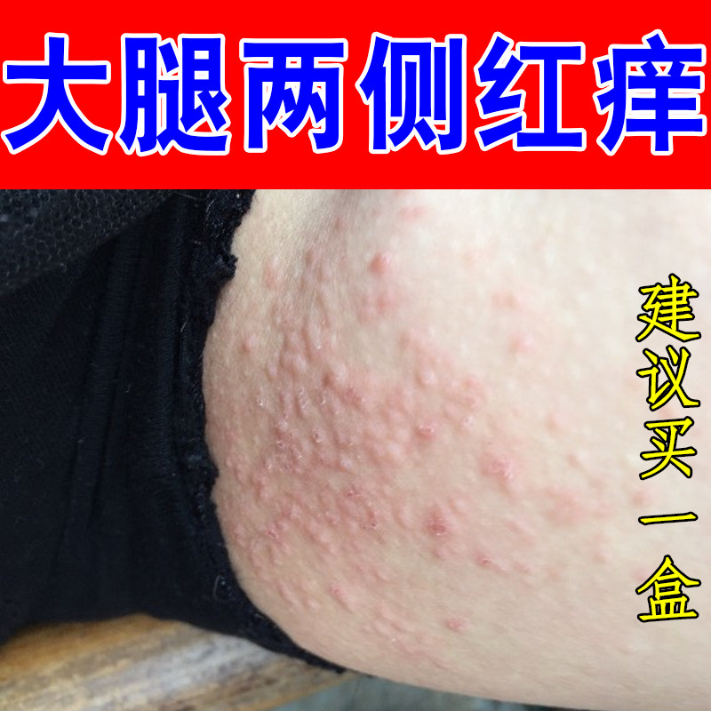 大腿内侧痒潮湿红肿男人下面痒季节性过敏痒掉屑腿上红点疙瘩痘痘