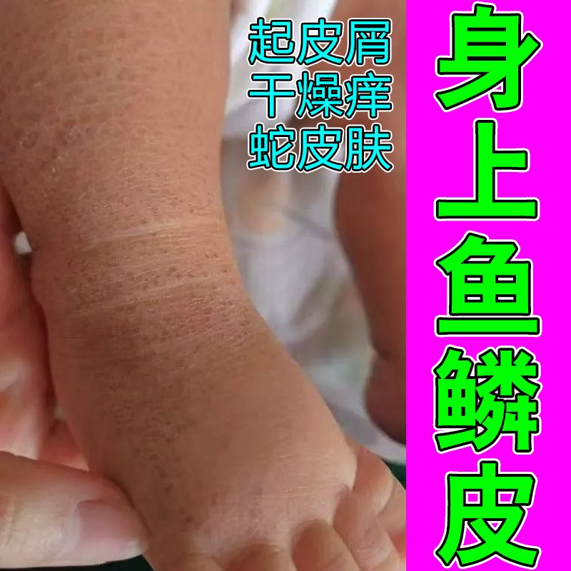 身上鱼鳞皮腿上粗糙干燥痒毛周角化症起疙瘩掉屑痒修复保油专用,美容护肤/美体/精油,乳液/面霜,淘宝优惠券,粉丝福利购,淘宝优惠卷