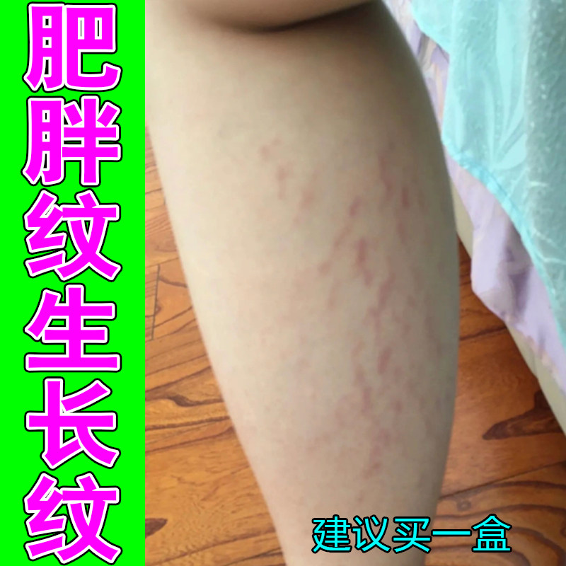 肥胖纹生长纹妊娠纹去学生白色纹路女人肚子腰腹上红紫色纹路专用
