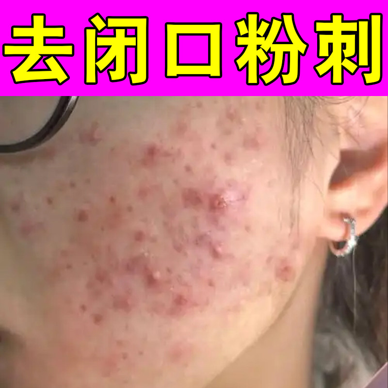 去闭口粉刺熬夜痘内分泌失调上火脸颊两侧腮边疙瘩脓包痘专用草本