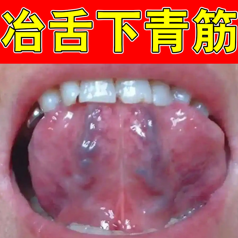 舌下青筋又黑又粗筋络发紫瘀血管怒张堵塞清洁一喷溶舌底草本喷剂