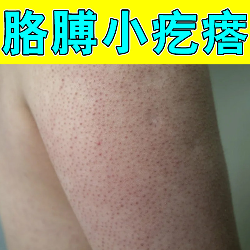 胳膊小疙瘩身上皮肤粗糙腿上毛周角化干燥小颗粒毛孔粗大毛囊堵塞