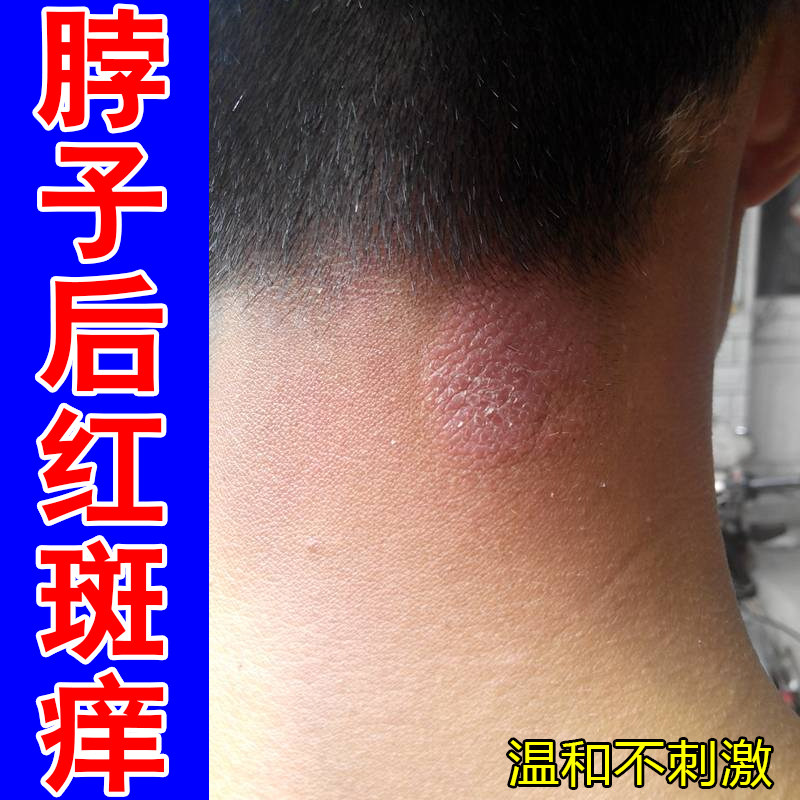 脖子后红斑痒掉屑粗糙过敏红肿神经性紫外线过敏起疙瘩红点刺挠痒